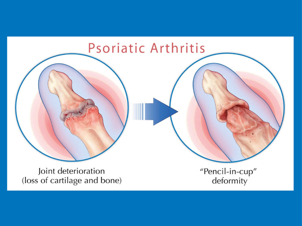 Artritis psoriásica y bimekizumab4