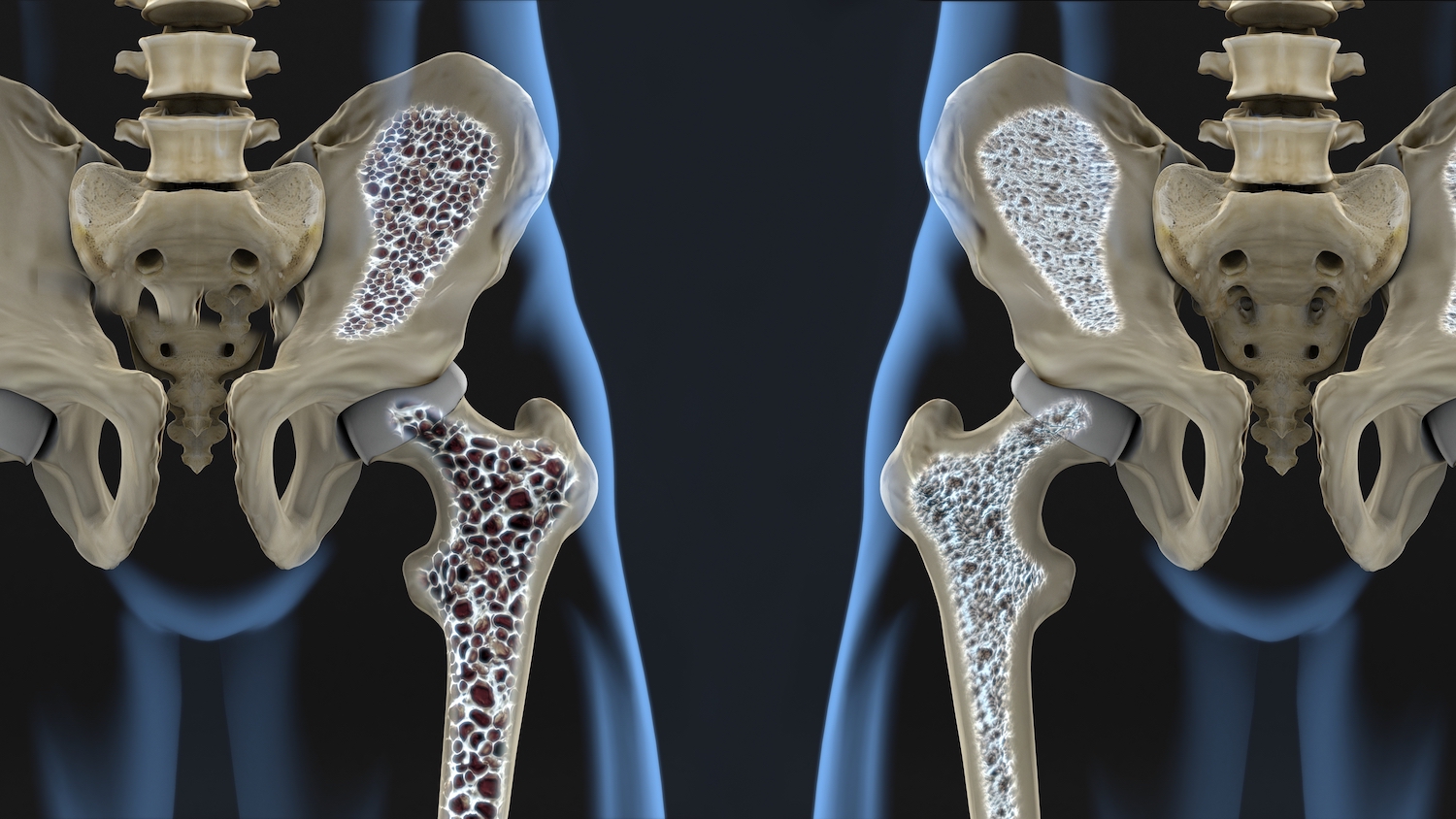 Osteoporosis inducida por glucocorticoides2