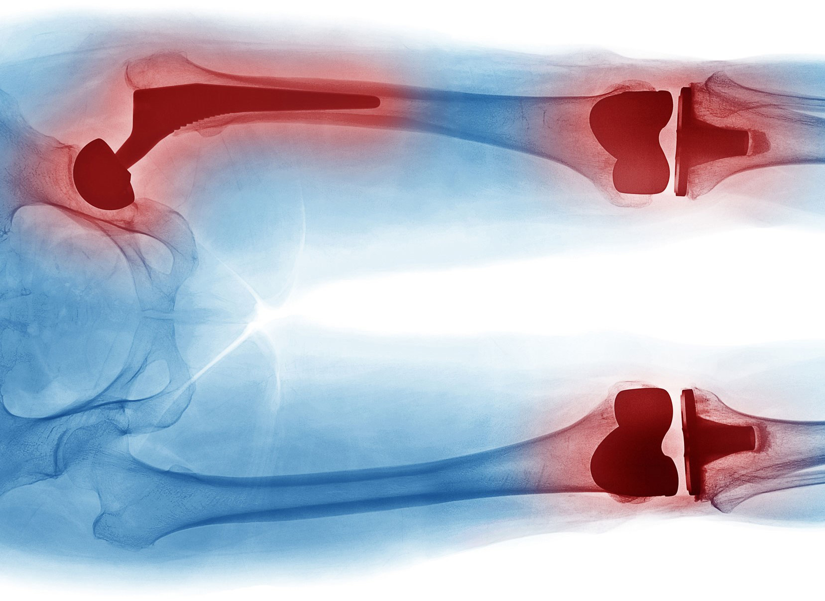 artroplastia de cadera 2