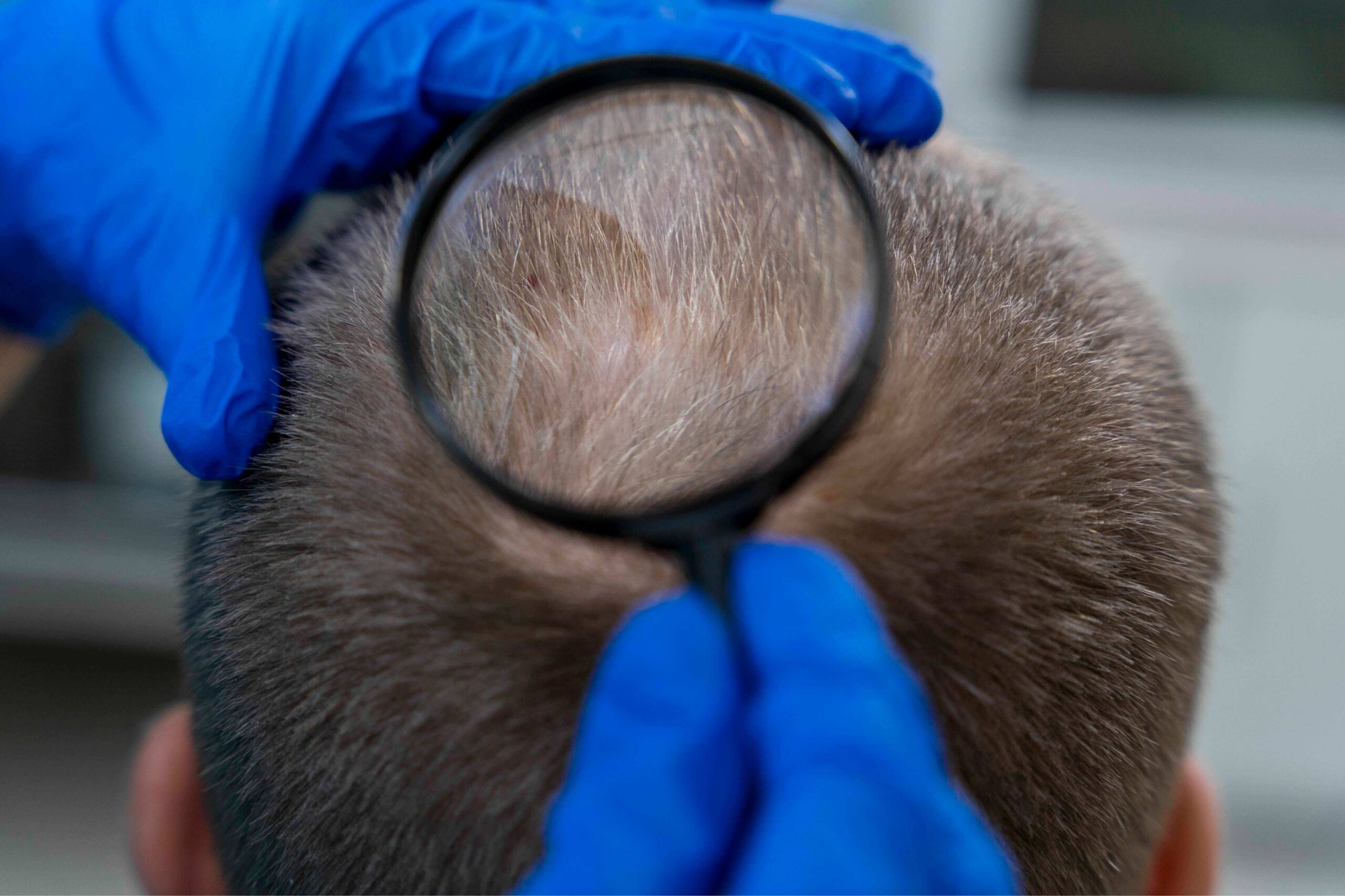 alopeciaareata.1