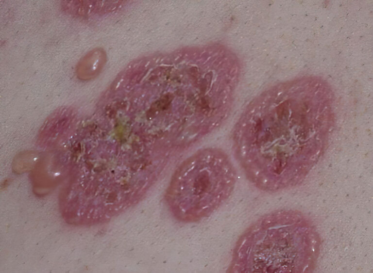 ampollar autoinmune por IgA lineal