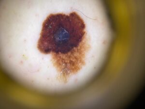 Diagnóstico de melanoma y nuevas tecnologías