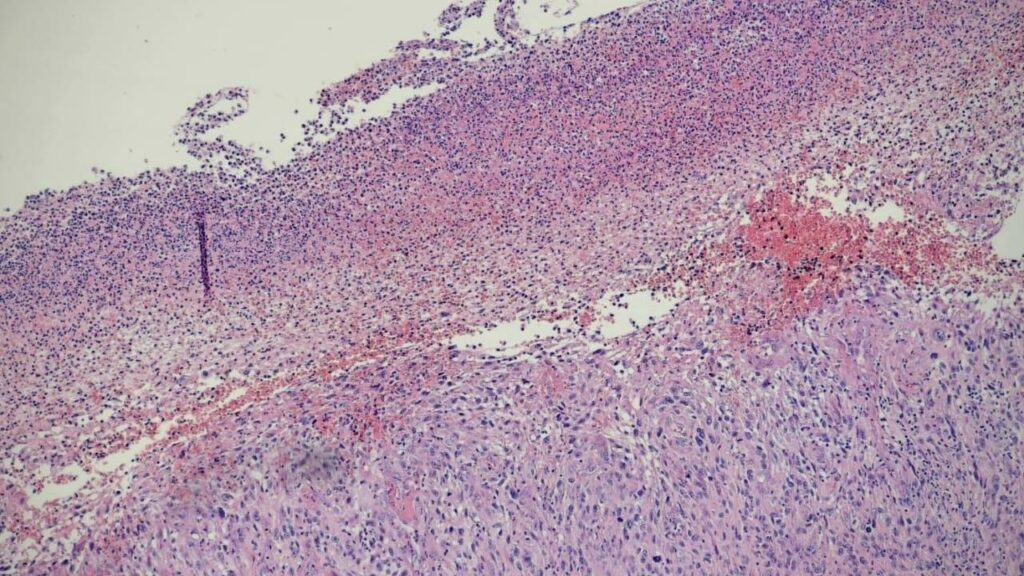 Fibroxantoma atípico y sarcoma pleomórfico dérmico