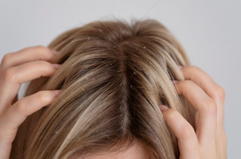 Dermatitis seborreica 2