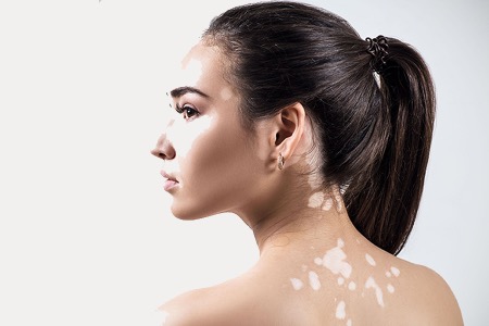 Vitiligo-preguntas1