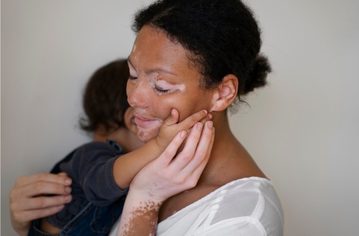 Vitiligo-calidad-de-vida1