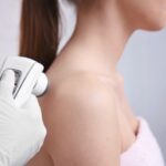 melanoma-laser-1