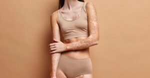 Insulina-y-vitiligo