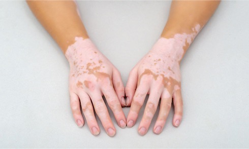 Insulina-y-vitiligo1