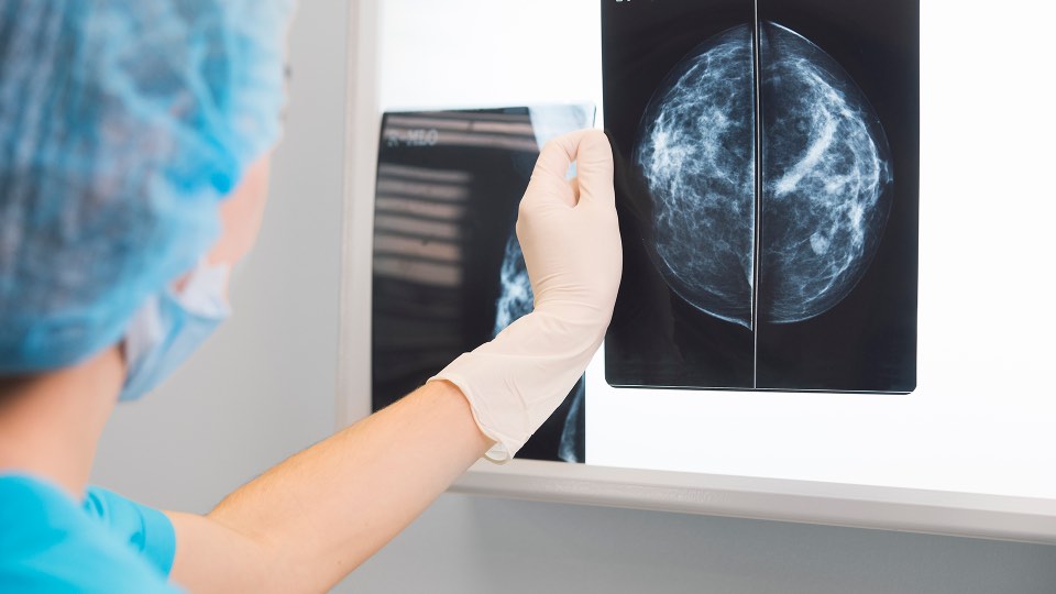 Mamografía y cáncer de mama3