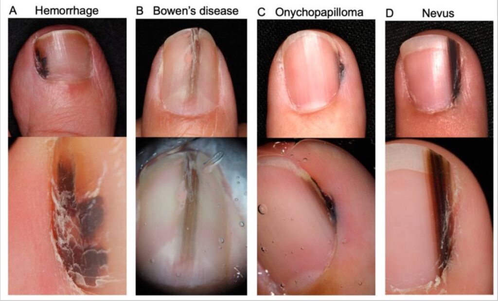 Melanoma-del-aparato-de-unas2