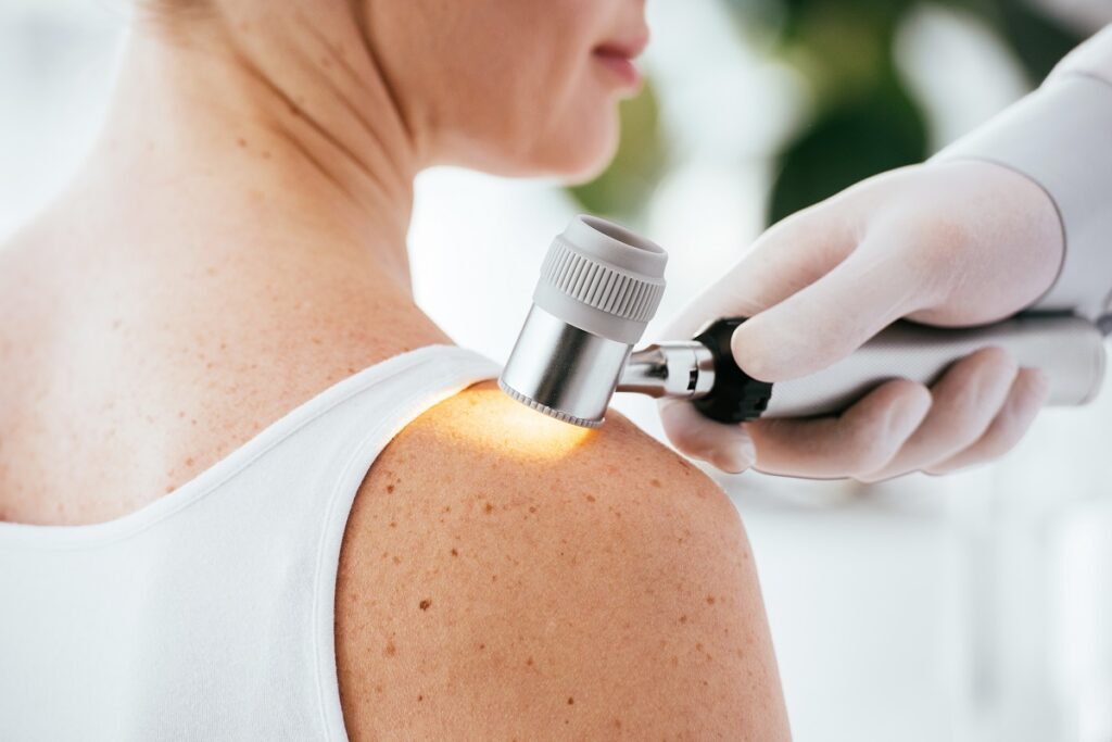 melanoma-laser-11