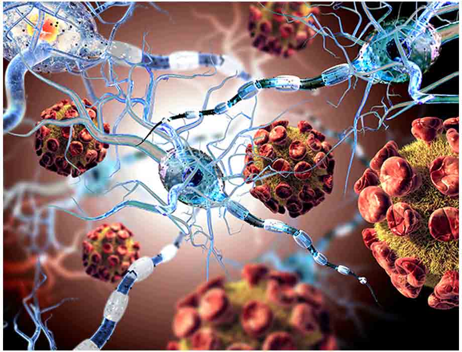 Esclerosis-lateral-amiotrofica-21