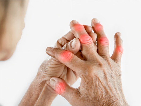 Herpes zóster artritis