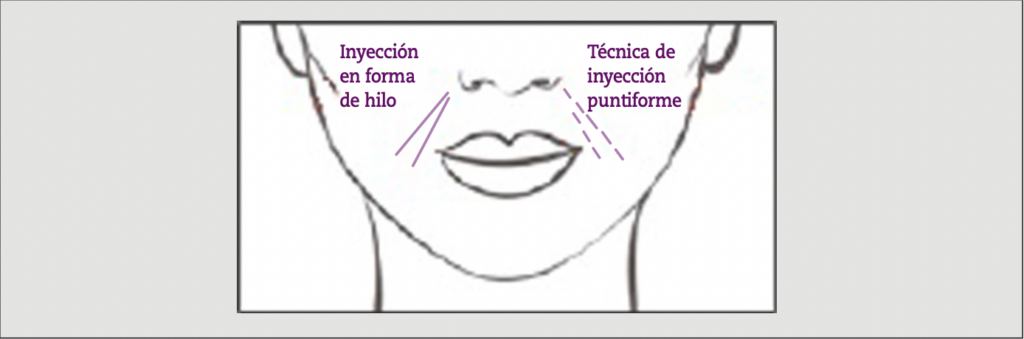 Hidroxiapatita-de-calcio-surcos-nasolabiales7