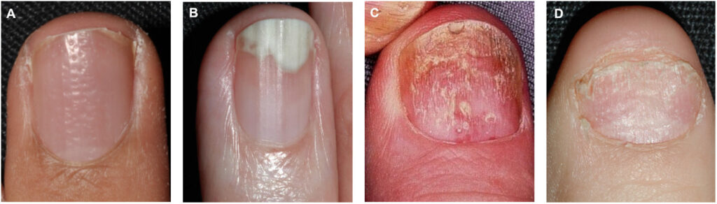 Psoriasis uñas