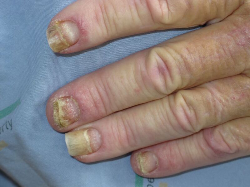 Psoriasis en las uñas - Lugones Editorial