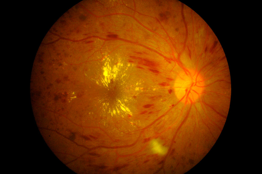 Inteligencia artificial y edema macular diabético3