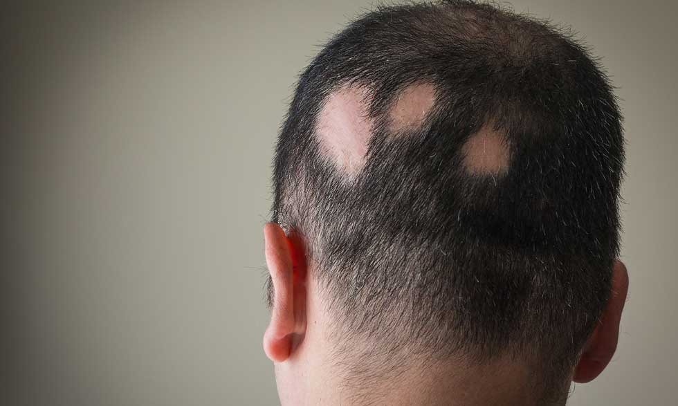 Comorbilidades psiquiátricas alopecia areata1