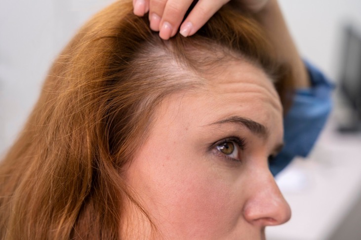 Comorbilidades psiquiátricas alopecia areata2