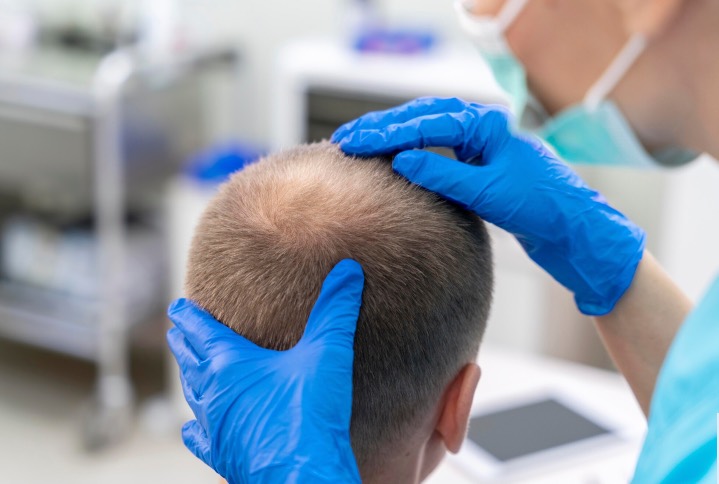 Comorbilidades psiquiátricas alopecia areata3