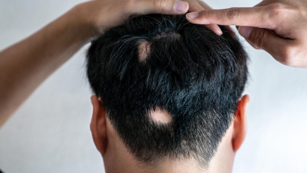 Comorbilidades psiquiátricas alopecia areata5