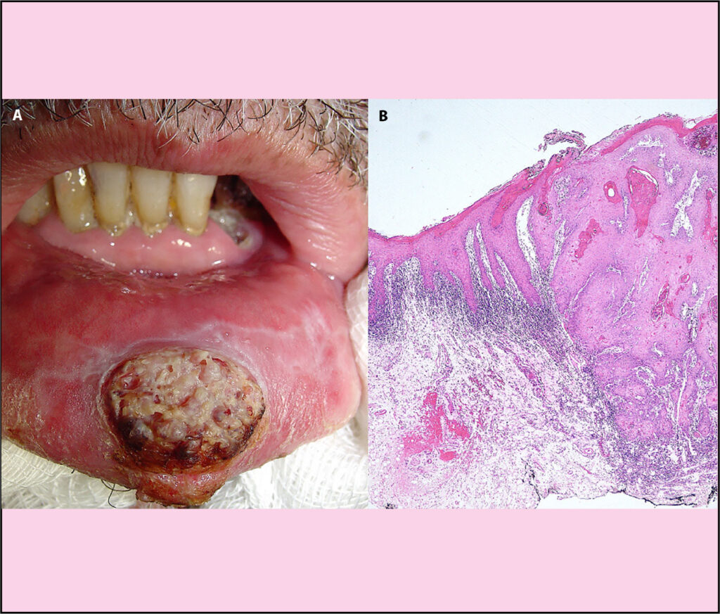 Úlcera de Marjolin en mucosa oral 1