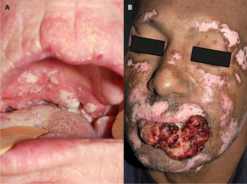 Úlcera de Marjolin en mucosa oral 3