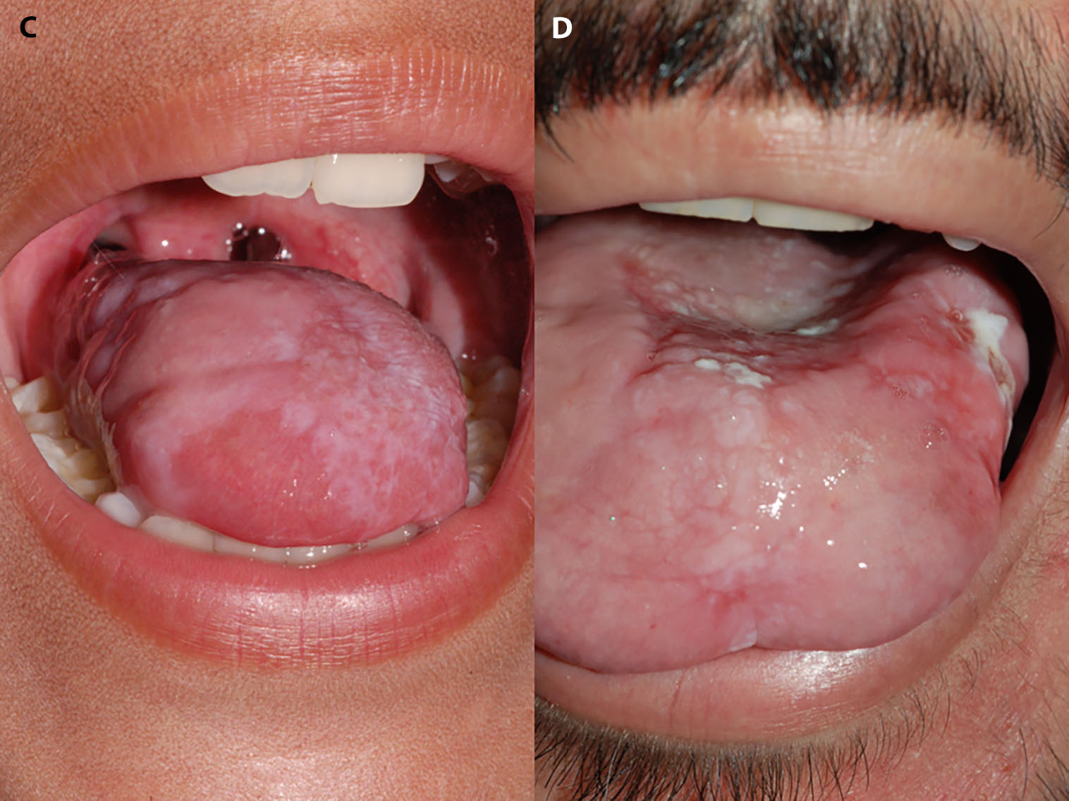 Úlcera de Marjolin en mucosa oral 4