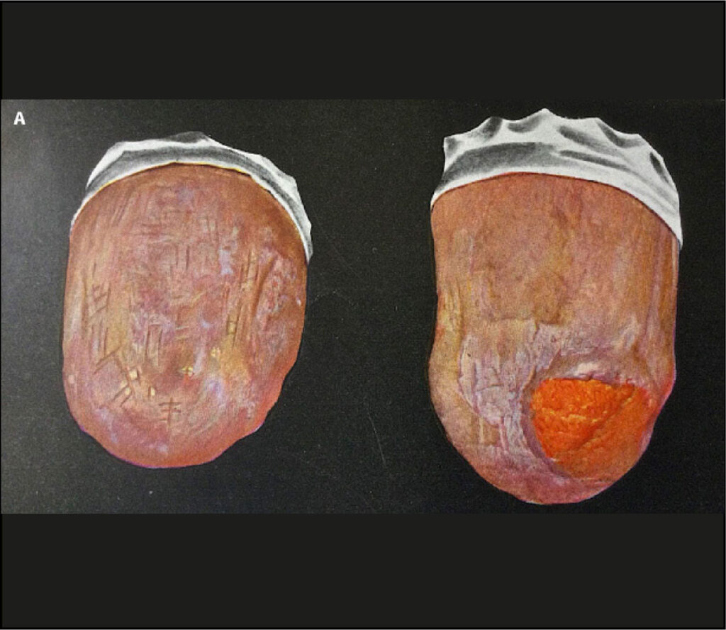 Úlcera de Marjolin en mucosa oral 5