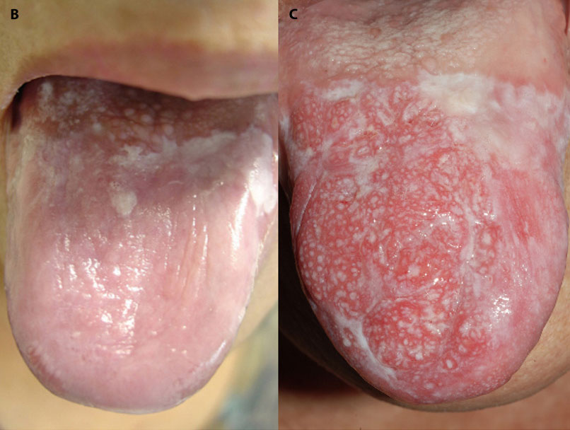 Úlcera de Marjolin en mucosa oral 6