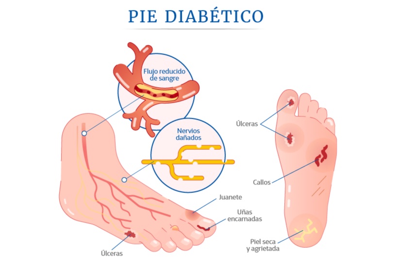 7Pie diabético diagnóstico y tratamiento