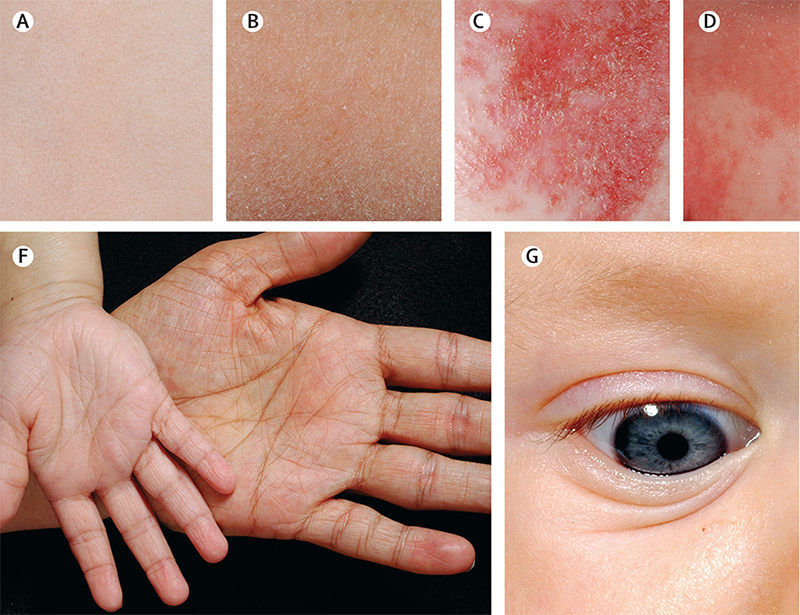 Dermatitis atópica: guía de práctica clínica-4