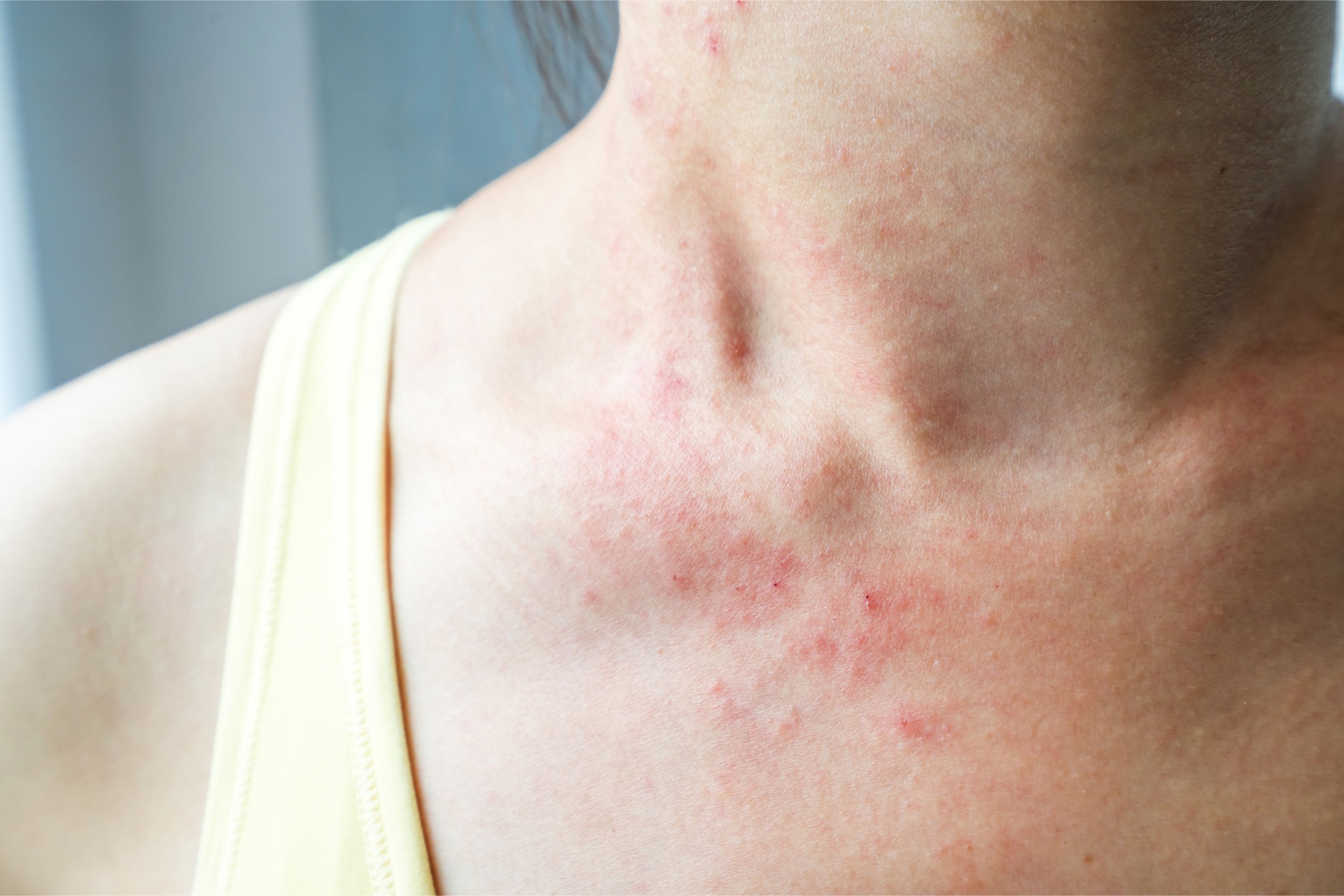 Dermatitis atópica 10 preguntas