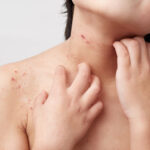 Dermatitis-atopica-10-preguntas7