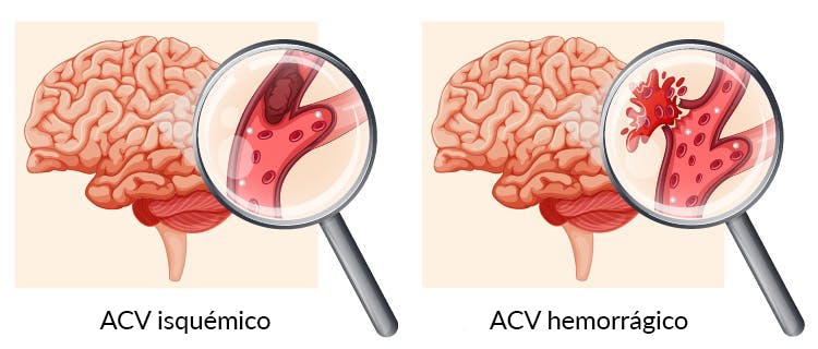 0 Atención accidente cerebrovascular