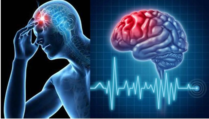 Accidente cerebrovascular en artritis1