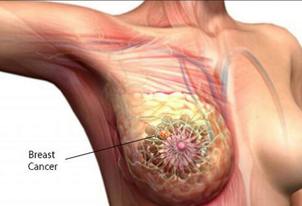 Metástasis cutáneas de cáncer de mama