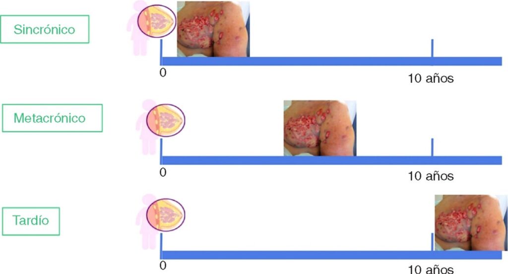 Metástasis cutáneas de cáncer de mama5