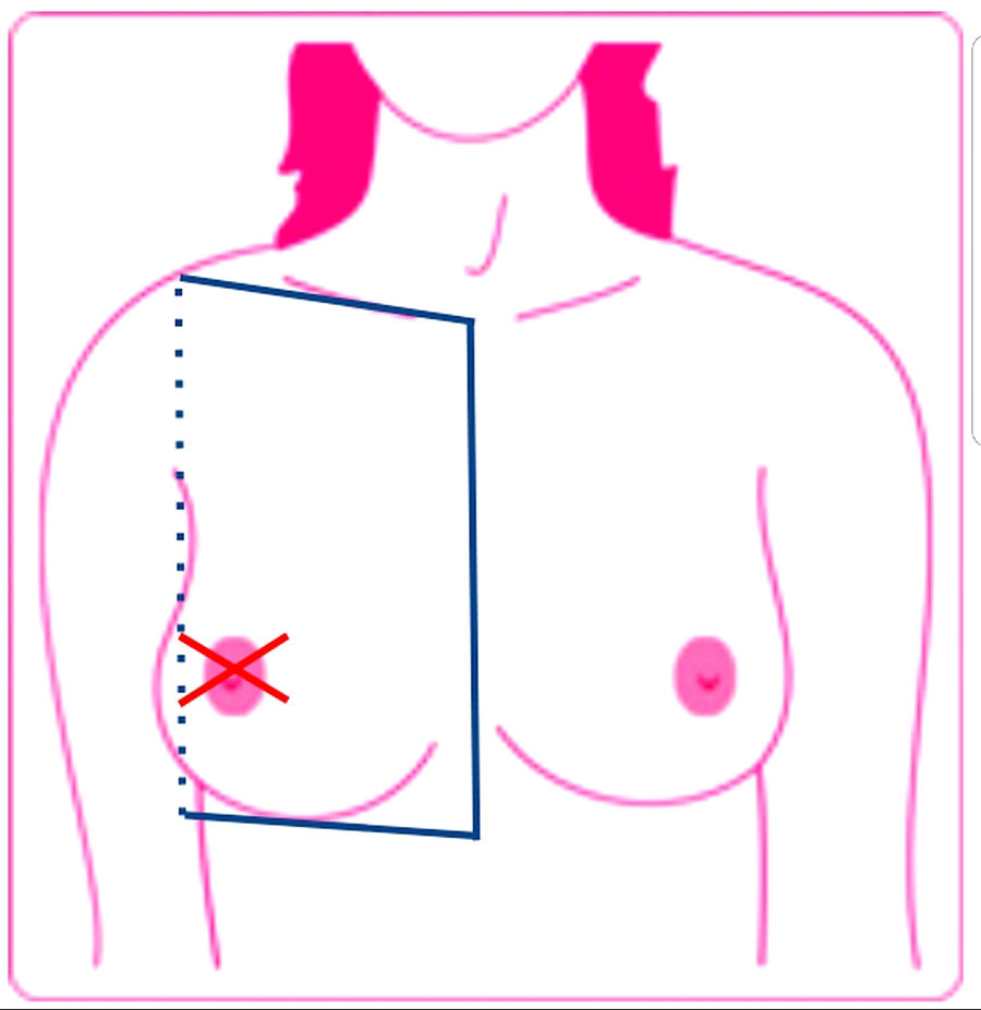 Metástasis cutáneas de cáncer de mama6