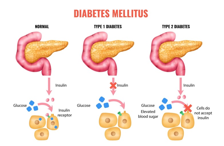 diabetes dia mundial bienestar