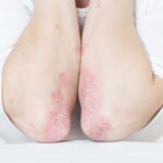 Terapia oral psoriasis deucravacitinib 17