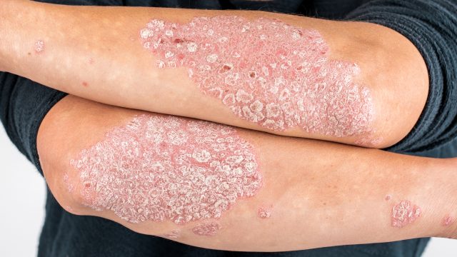 1 Psoriasis y diabetes