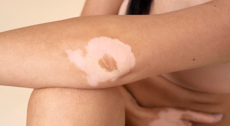 1 vitiligo Tratamiento