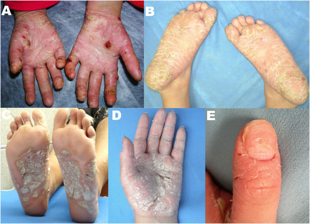 2. Psoriasis palmoplantar niños