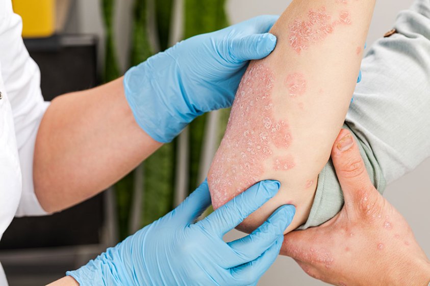 4 Psoriasis de moderada a grave