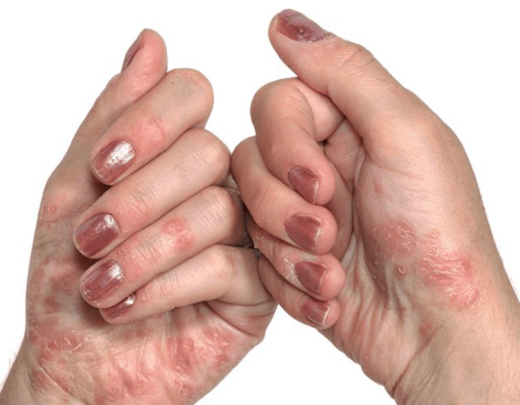 4 Psoriasis y diabetes