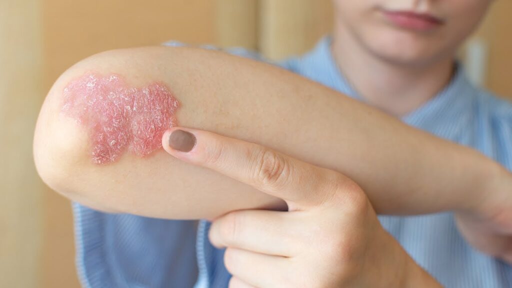 5 Psoriasis y diabetes