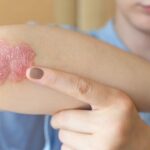 5 Psoriasis y diabetes