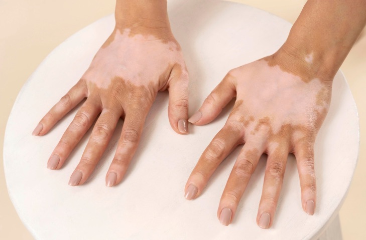 6 vitiligo Tratamiento